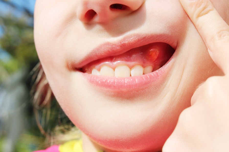 عوامل عفونت دندان