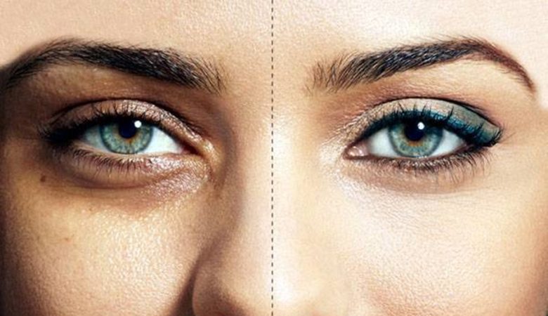 بعضی از علت‌های عمده تیره شدن پوست زیر چشم، وراثت،بالا رفتن سن و...است